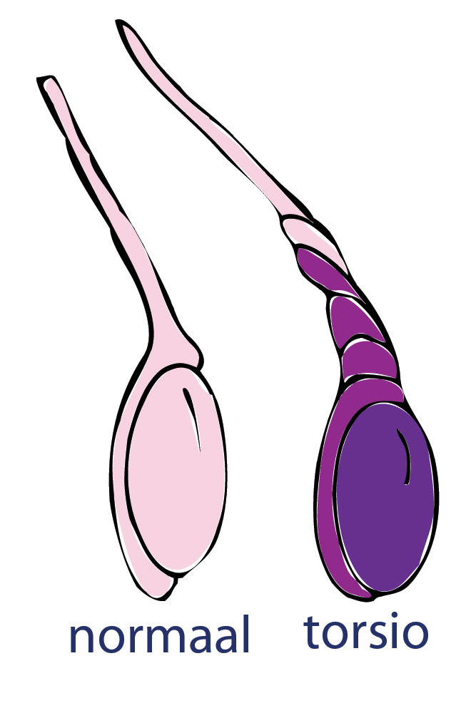 torsio testis