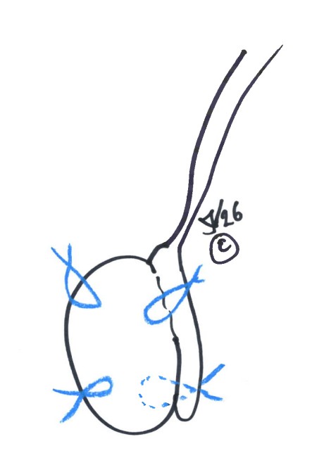 orchidofixatie na de-torsio testis